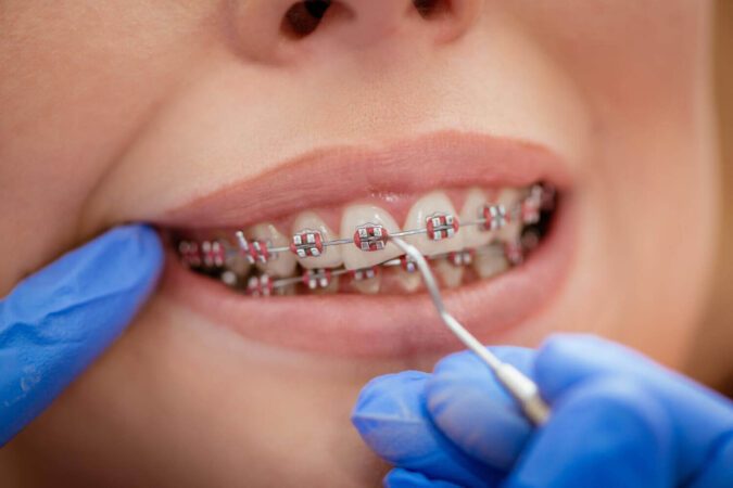 Uczulenie na aparat ortodontyczny – jakie są objawy, czego unikać i co zrobić?