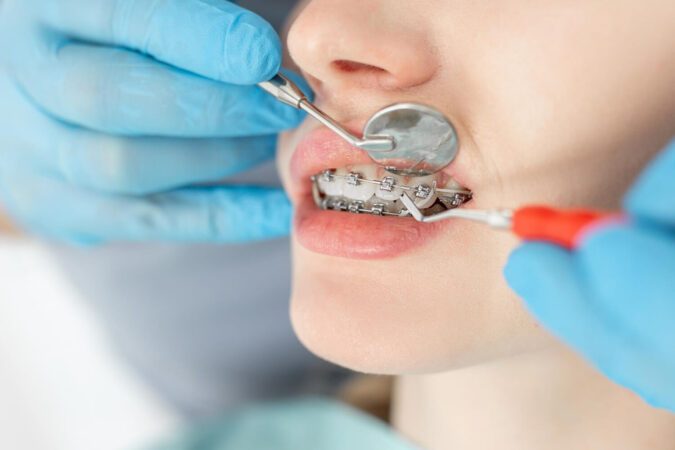 Ból zęba podczas noszenia aparatu ortodontycznego – jak temu zaradzić?